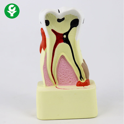 El modelo dental de los dientes de la comparación de la carie/la demostración dental modela para enseñar