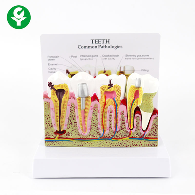 Exhibición común de las patologías de los dientes del decaimiento médico humano dental periodontal del modelo